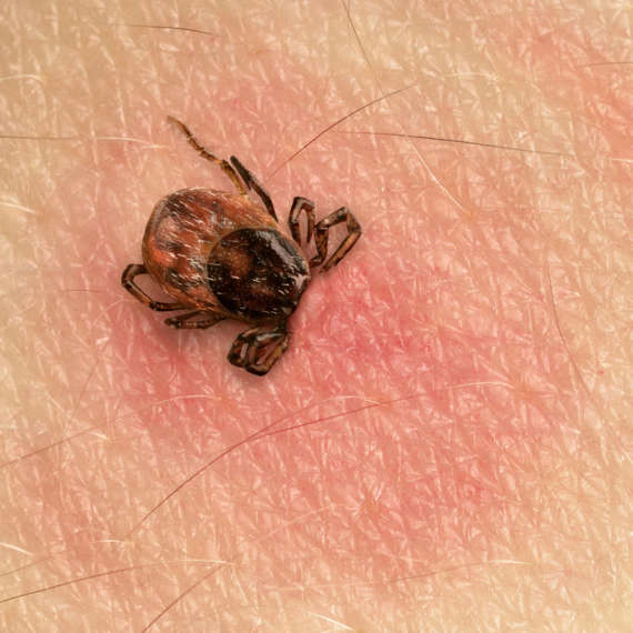 you need to remove all of the pieces of a tick during removal, especially the head