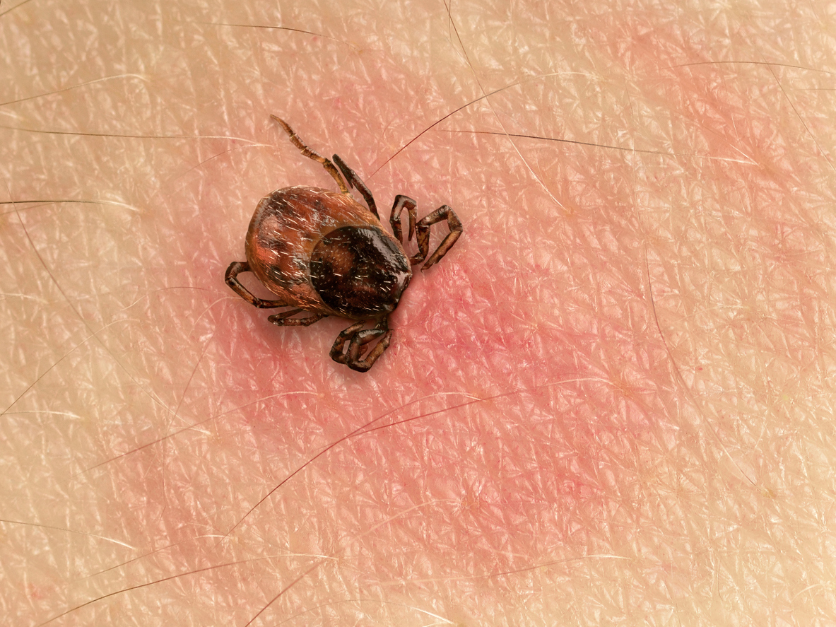 you need to remove all of the pieces of a tick during removal, especially the head